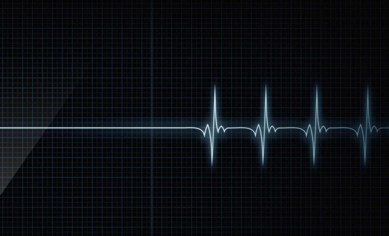 Пульс остановился. Кардиограмма остановки сердца. Линия кардиограммы. Смерть на ЭКГ. Пульс.